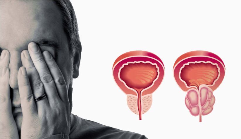 Przewlekłe zapalenie prostaty