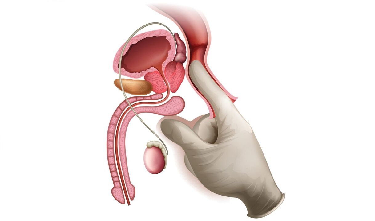 masaż prostaty na zapalenie gruczołu krokowego
