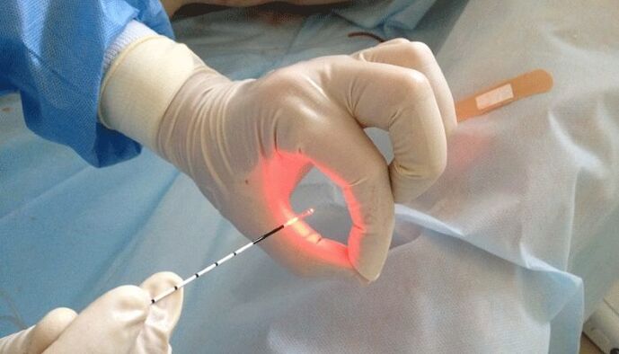 laserowe leczenie zapalenia prostaty